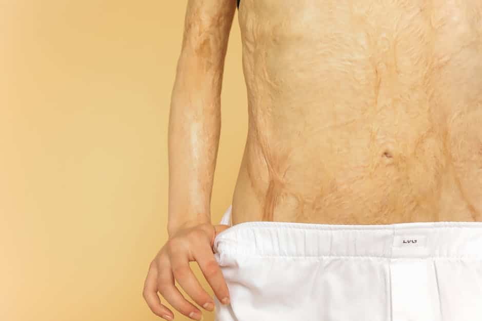 Chesterfield burn injury lawyer